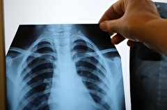 Заболеваемость туберкулезом в Москве за последние 10 лет снизилась более чем в три раза
