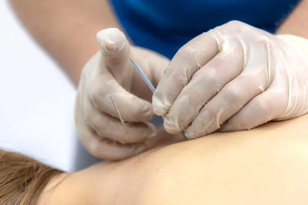 Акупунктура: польза и вред для здоровья, эффект и кому делать нельзя