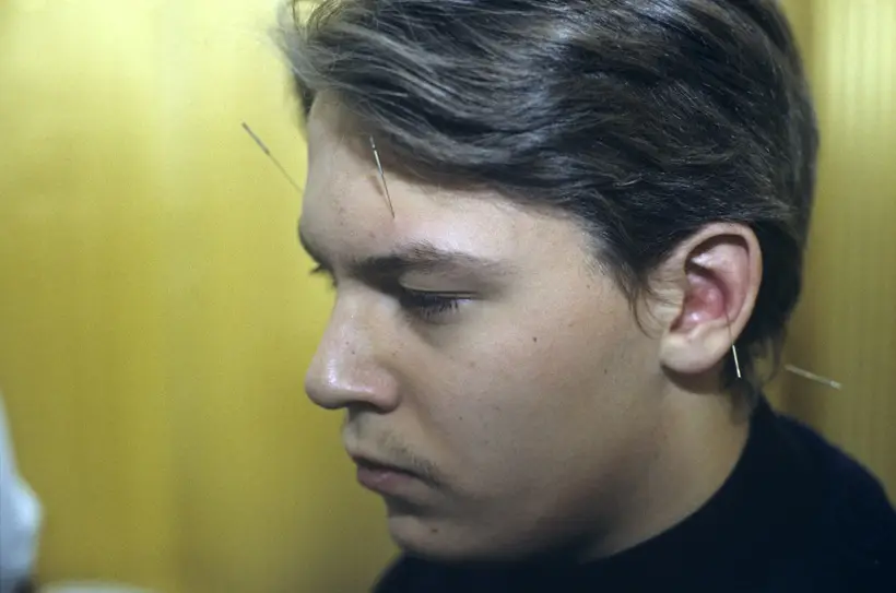 Акупунктура: польза и вред для здоровья, эффект и кому делать нельзя