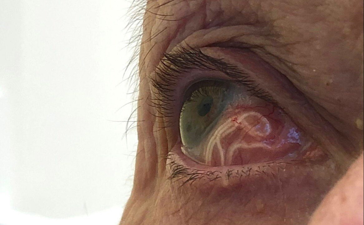 Офтальмологи спасли рязанке зрение, удалив из глаза червей